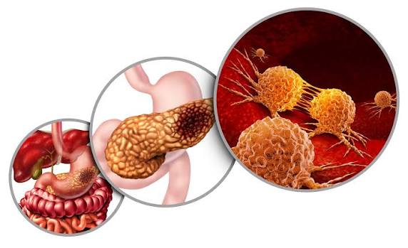 Nuove frontiere nel carcinoma pancreatico
